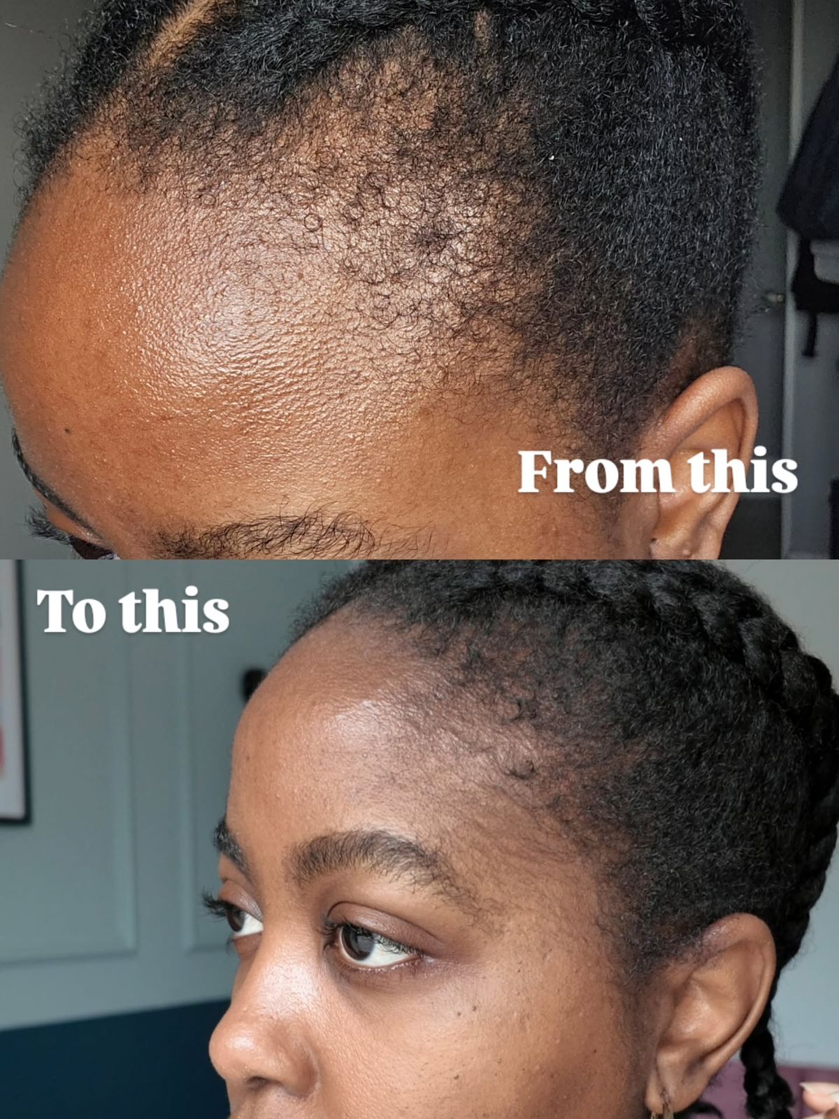 Traitement Repousse Cheveux Minoxidil 5 %