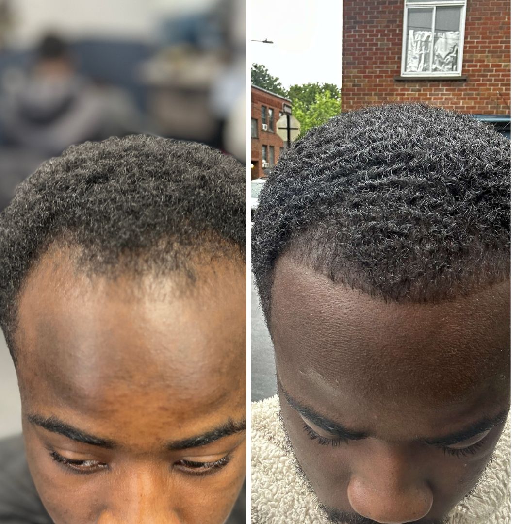 Traitement Repousse Cheveux Minoxidil 5 %