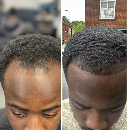 Traitement Repousse Cheveux Minoxidil 5 %